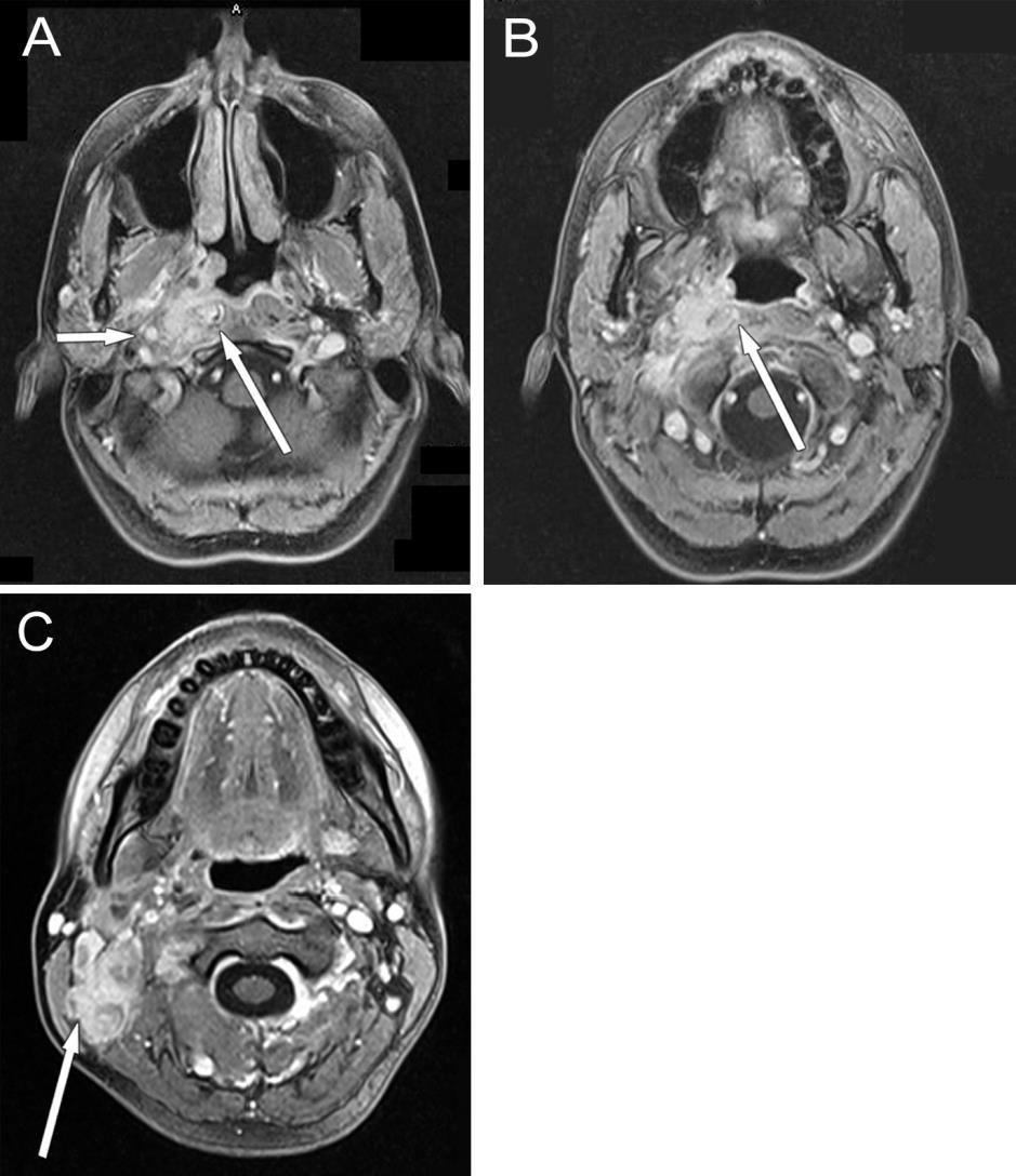 18. ábra Nasopharynx carcinoma, T4 N1 stádium 3T MR képek, axiális síkú CE-T1-FS mérések. A, B: jobb oldalon submucosusan terjedő tumor képe látható.
