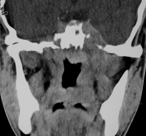 A jobb oldali bázis destrukción keresztül az orrgarat daganata szélesen terjed intracraniálisan a sinus cavernosusba (nyíl).