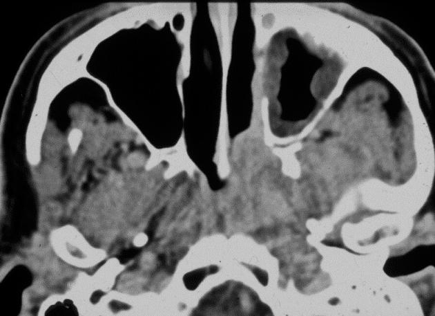 23. ábra Orrgarat rák terjedése ventrálisan a processus pterygoideus mediális lemez destrukciójával, T3 stádium Axiális síkú kontrasztos CT réteg.