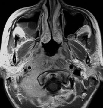 Perineurális terjedés lehetőségét a tumor elhelyezkedése, terjedése szerint 18 (21%) betegnél vetettük fel, a direkt és indirekt jelek összevetése alapján.
