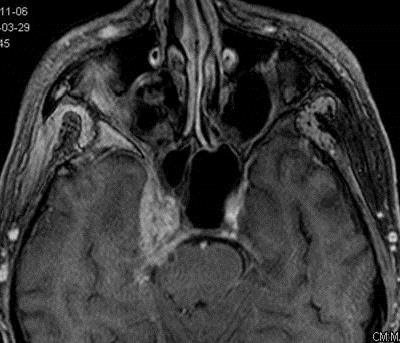 A B C D E F 25. ábra Intracraniális, perineurális terjedés a nervus trigeminus mentén, T4 stádium Felső MRI képek, A. Coronális-, B.