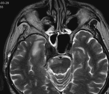 (hosszú nyíl). Alsó sor CT rétegek, D, E: coronális síkúak, F: axiális síkú, a csontos koponyabázis destrukciója jelzi a tumor terjedését.