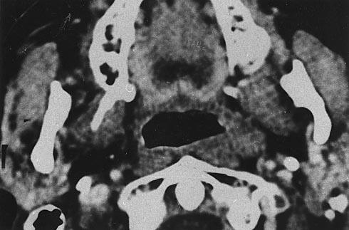 adenocarcinoma bár nem sugár érzékeny tumor, de posztoperatív irradiációja ajánlott, mivel a daganat kedvező biológiai tulajdonságát előnyösen egészíti ki a radioterápia és javítja a