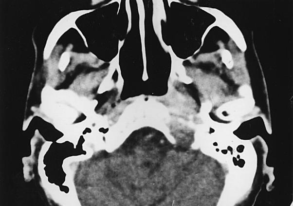 SAJÁT KUTATÁS - Orrgarat (OG) carcinoma helyi kiújulásánál alkalmazott újabb sugárkezelés Lengyel E, Baricza K, Somogyi A, Olajos J, Pápai Z, Gődény M, Németh Gy, Ésik O.