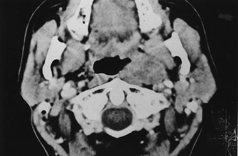 Strahlentherapie und Onkologie, 179(5): 298-305, 2003 Az OG daganatok öt éves átlagos túlélése a primer tumor kezelése után 35-60%.