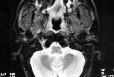 A stádium újabb meghatározása CT-vel és / vagy MRI-vel a koponyabázistól a trachea bifurcatióig történt. A betegek mellkas CT- és hasi UH vizsgálaton is átestek.