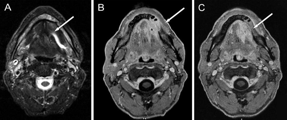 28. ábra Szájüregi (szájfenék) carcinoma, T4a stádium 3T MRI, axiális síkú rétegek, A: STIR B és C: CE-T1-FS szekvencia.