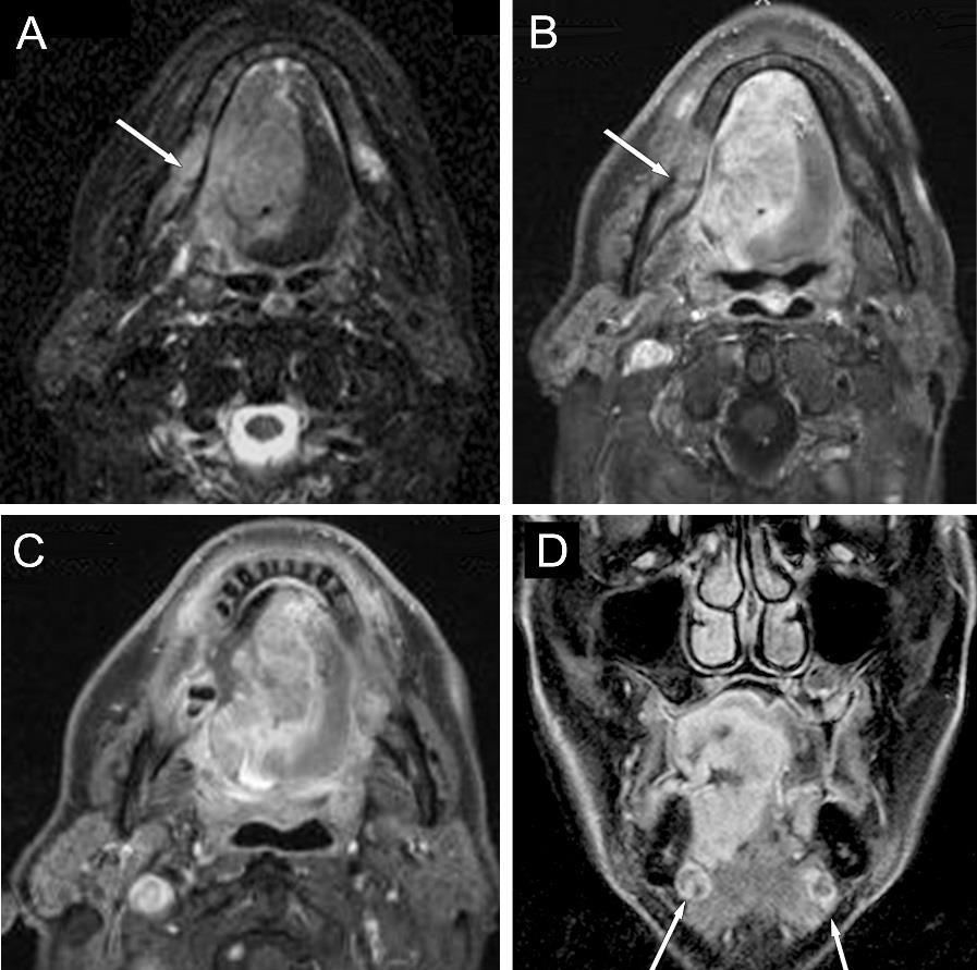 (30, 31. ábrák) 30. ábra Szájüregi-, nyelv carcinoma, T2N2c stádium 3T MP-MRI.