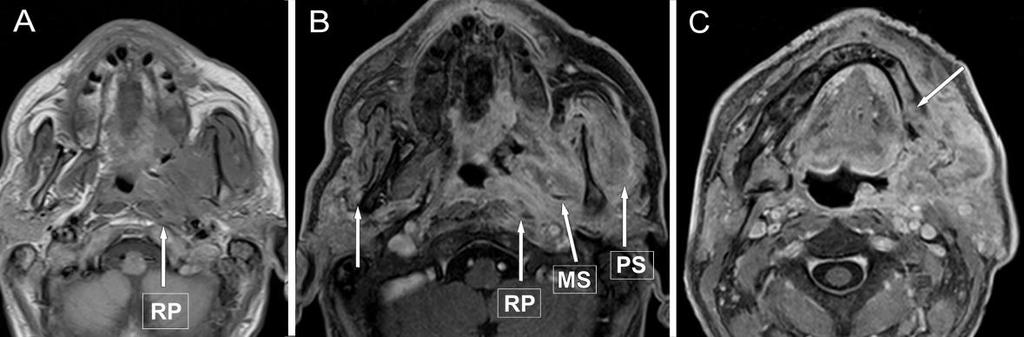 Ezen a területen a lymphoid hyperplasia és a malignus lymphoma előfordulása is gyakori, melyeket nem mindig lehet a carcinomától elkülöníteni.