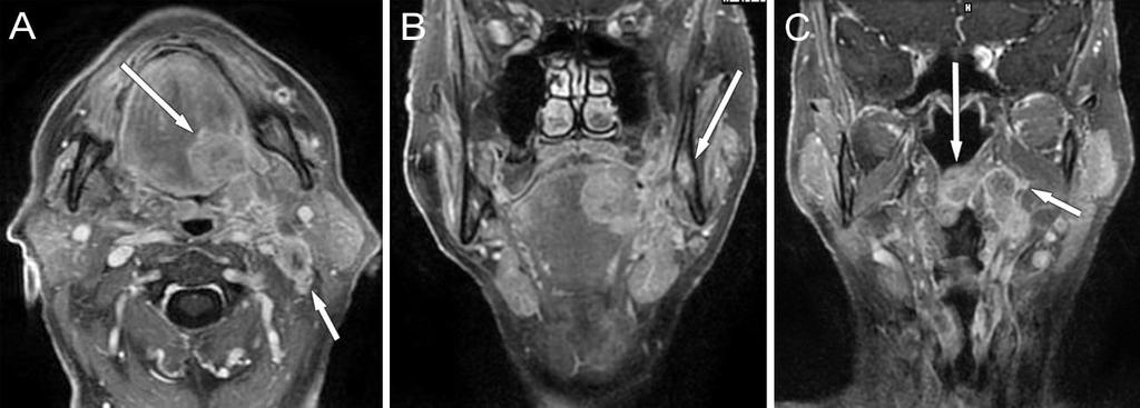 35. ábra Mesopharynx carcinoma nyelvgyökben, tonsilla palatinában, T4aN2b stádium 3T MR képek, CE-T1-FS mérések.