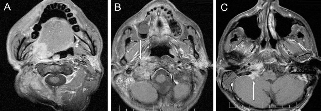 B, coronalis síkú: a tumoros infiltráció a trigonum retromolare felé terjed és a mandibula szögletben a csontvelő tumoros infiltrációját (hosszú nyíl) eredményezi.