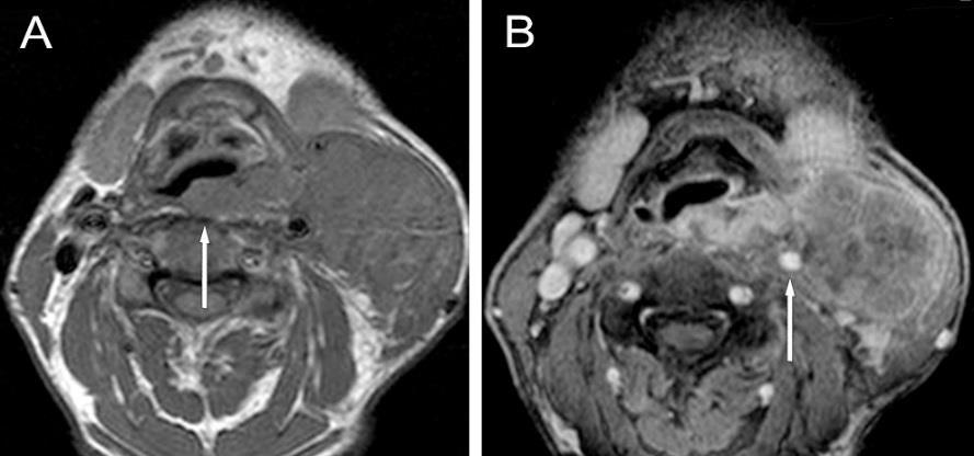 ábra Hypopharynx carcinoma supraglotticus-, nyelvgyöki terjedéssel, T4aN2c stádium A: axiális T2- B: axiális T1-súlyozott MRI képeken az algarat hátsó és jobb oldalsó falán tumoros lágyrész látható.