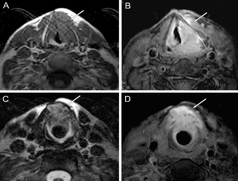 40. ábra Gégerák supra- és subglotticus terjedéssel, T4a stádium 1.5 T MRI, axiális rétegek, A: T1-súlyozott, C: T2-súlyozott, B, D: CE-T1-FS képek.