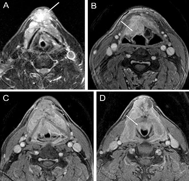 A tumor supraglotticus terjedése (A és B képek) involválja a bal plica aryepiglotticát, infiltrálja a pajzsporc bal lemezét és azon át terjed a bőr alá (nyíl).