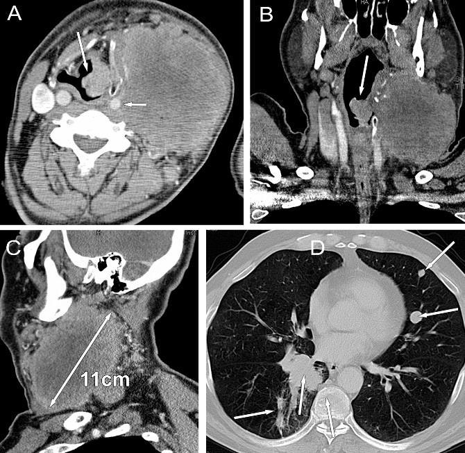 42. ábra Supraglotticus gégerák, T2 N3, klinikai stádium: IV C. 16-MDCT-vel készült vizsgálat, kontrasztanyagos, multiplanaris rekonstrukciókkal.