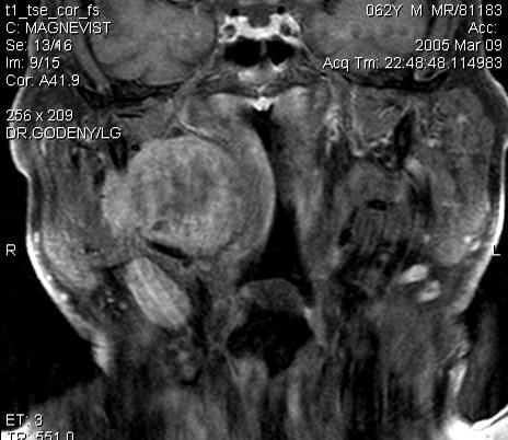 ábra Adenoid cysticus carcinoma a parotis mély lebenyében, tüdő és csont áttéttel, stádiumat4a, N1, M1 A: T2-w axiális