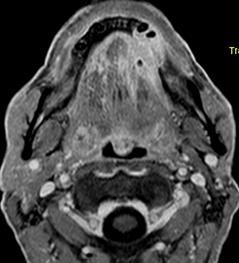 A: STIR axiális MR kép, a tumor komprimálja a submandibuláris vezeték szájadékát, a vezeték tágulatát okozza.