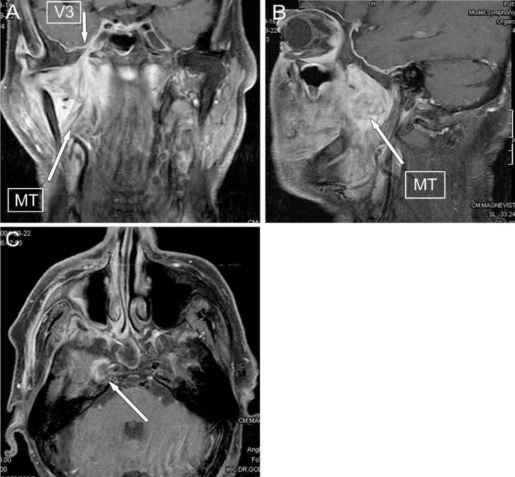 kérdések: a mandibula, sziklacsont, koponyabázis, pterygoideus patkó, kilépő agyidegek állapota, az intracraniális terjedés, az arteria carotis interna tumoros infiltráltsága, a hematogén szóródás