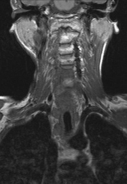 A tiszta follicularis carcinoma ritka, gyakoribb, ha papillaris carcinomával keveredik.