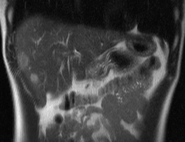 pajzsmirigy carcinomákkal együtt fordul elő. UH-val leggyakrabban echoszegény, CT-vel az esetek több mint felében amorph meszesedést és necrosist mutat.