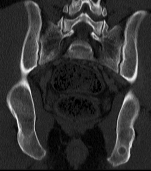 A medullaris carcinoma 80-90%-ban kalcitonint termel, jó prognózisú, 10-20 %-ban familiárisan fordul elő.