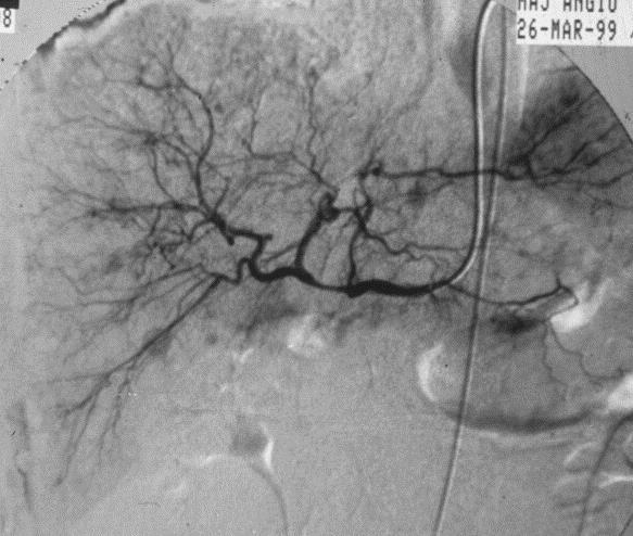 A B 46. ábra Szövettannal igazolt medulláris pajzsmirigy carcinoma máj áttétei az angiográfiás képeken Huszonkilenc éves ffi beteg. Angiografia, A: artériás-, B: parenchymás fázis.