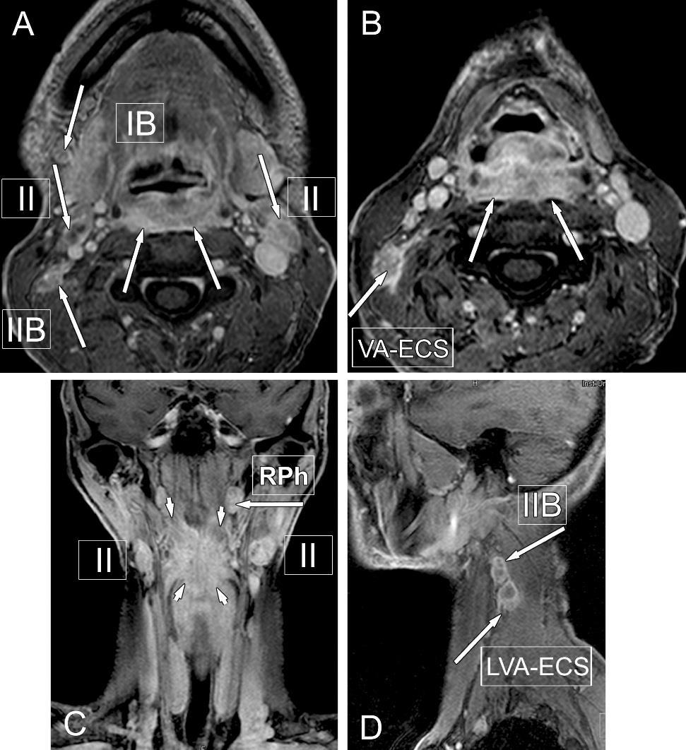Rossz prognosztikai jel a 6 cm-nél nagyobb nyirokcsomó és az extracapsularis tumor terjedés. 47. ábra Nyaki nyirokcsomó régiók szintjei 48.