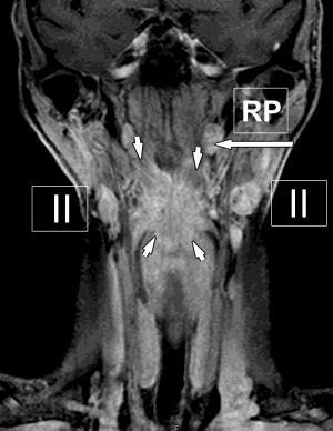 síkú rétegeken jól értékelhető a hátsó garatfal carcinoma, a kiterjedt, kétoldali, nyirokcsomó metasztázis.