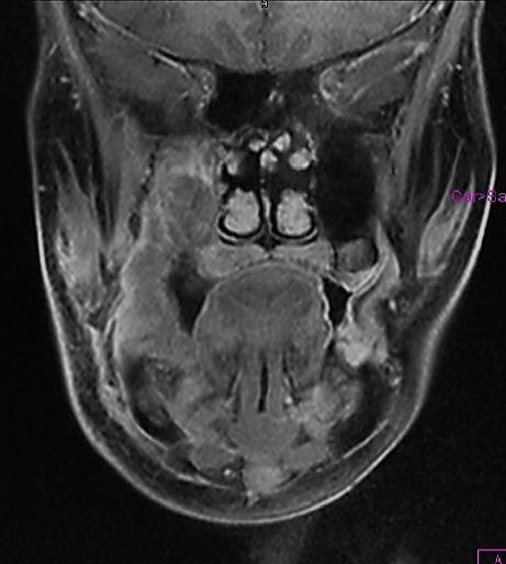 (rövid nyíl) C D Bucca, gingiva tumor (fenti eset) kemoradio terápia után C: STIR axiális-, D: CE-T1-FS, coronalis síkú réteg.