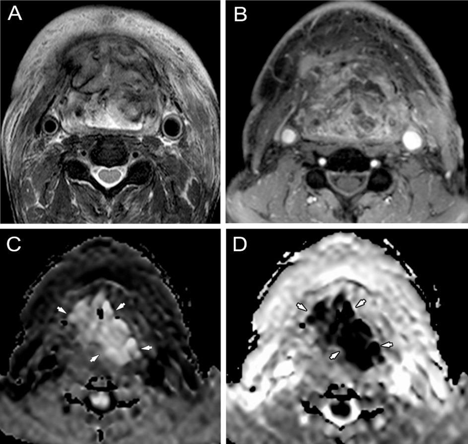 51. ábra Posztterápiás tumor residuum, supraglotticus gégerák kemo-radioterápia után 3T MP-MRI, axialis síkú rétegek, A: T2-súlyozott zsírsuppresszióval (T2-FS), B: CE-T1-FS, C: DW- MRI, D: ADC kép.