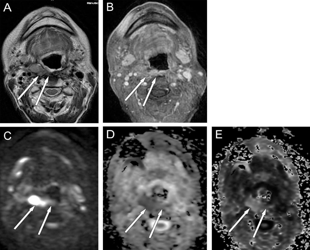 A DW-MRI képen (b:1000 sec/mm 2 ) magas jelintenzitású és az ADC képen alacsony jelintenzitású szerkezeti eltérés utal a tumor residuumra. 52.