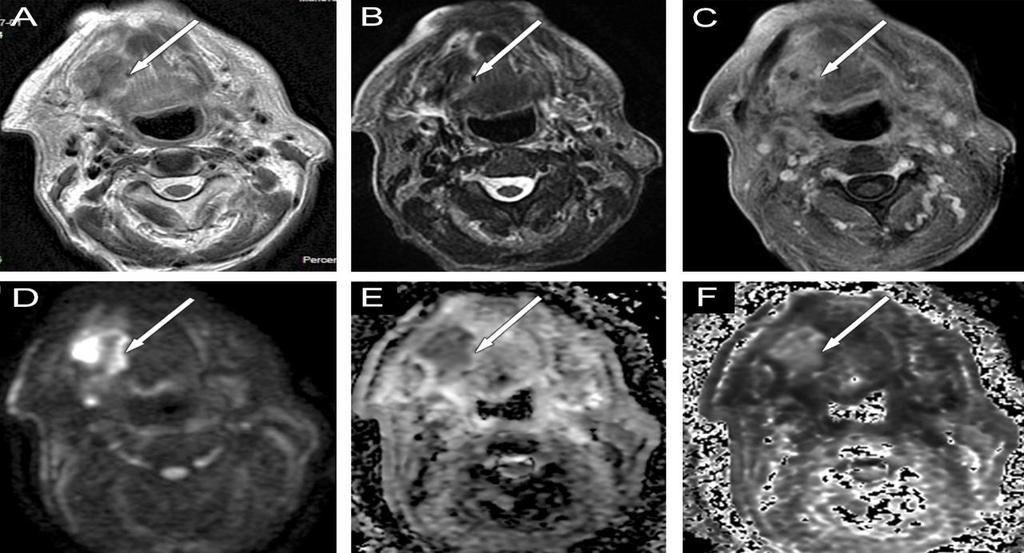 A DW-MRI talán a leghasznosabb módszer a terápia hatékonyságának megítélésére, és a reziduális tumor, valamint a posztterápiás reziduum elkülönítésére. (Thoeny 2010, Thoeny 2012) (54, 55, 56.