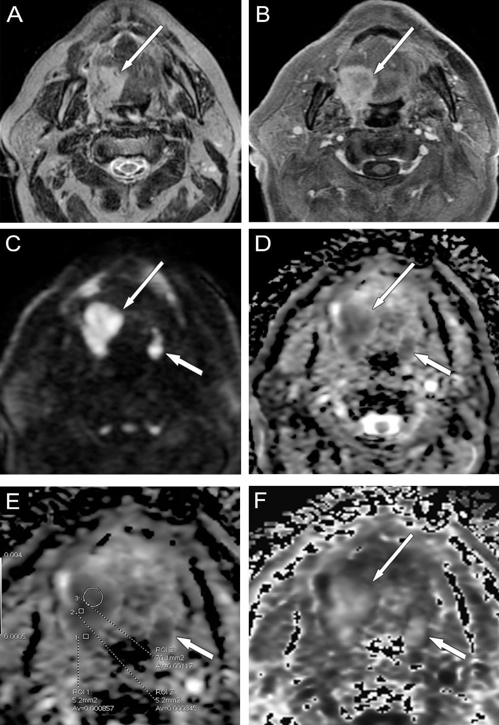 55. ábra Tonsilla palatina carcinoma, mindkét oldalon A jobb oldali nagyobb tumor (hosszú nyíl) beterjed a nyelvgyökbe, a bal oldali tumor kisméretű (rövid nyíl).