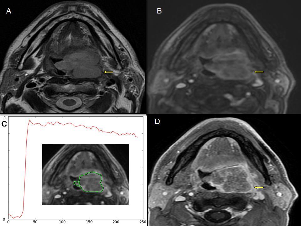 56. ábra Bal oldali mesopharynx carcinoma, nyíl mutat a primer tumorra A: T2-súlyozott natív sequentia, B: Fast spoiled gradient echo (FSPGR) dynamikus méréssel készült réteg, 3 sec alatt.