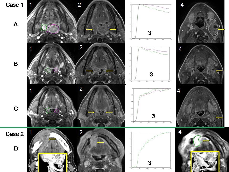 A Sor, Eset 1: Kétoldali tonsilla palatina carcinoma, kezelés előtt: dinamikus mérések, ROI mindkét tumoros oldalon (A1), dinamikus kontrasztos T1FS (DCE-T1-FS) sequencia, nyilak mindkét tumorra
