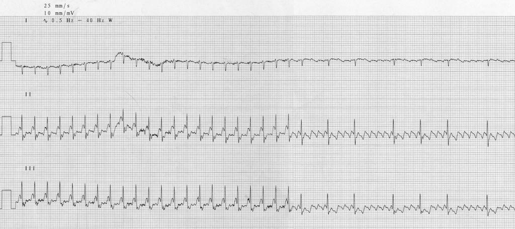 Pitvari flutter adenosine