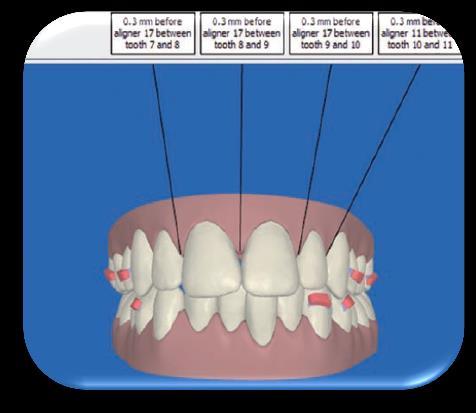 Laboratórium Szoftver Invisalign: ClinCheck Virtuális kezelési tervet minden oldalról,