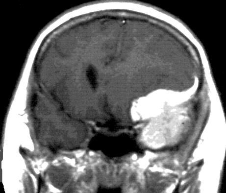 Meningeoma Extraaxialis Supra-, infratentorialis Convexitas, basalis, intravenricularis