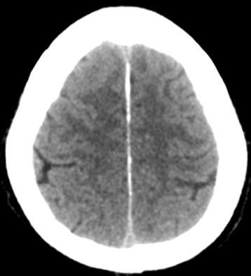 hydrocephalus, NPH) Tág kamrák Szűk