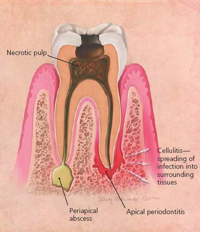 Az apikális periodontium gyulladásos kórfolyamatai A fogakat támasztó, rögzítő kemény- és lágyszöveteket nevezik periodontiumnak, azaz fogágynak, A periodontiumot a fognyak és a marginalis gingiva
