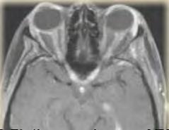 Trigeminus neuropathia Agyideg-érintettség Általában kizárólag szenzoros, izoláltan vagy egyéb tünet progressziójaként jelentkezhet Patogenezis: a ggl.