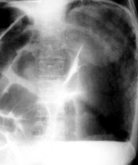 Pneumoretroperitoneum perforatio