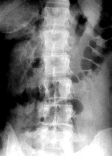 Kóros gázgyülem Pneumoperitoneum