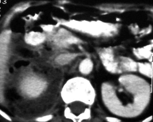 Pneumoretroperitoneum perforatio