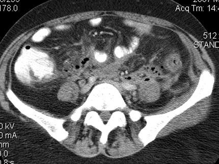 perforatio iatrogen per