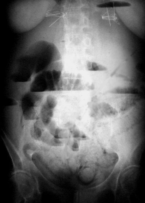 Kóros gázgyülem Pneumoperitoneum