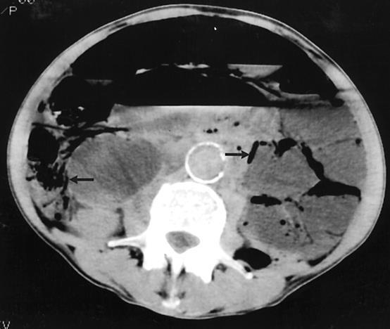 Pneumoretroperitoneum perforatio