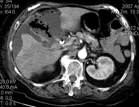 portae mesenterialis infarctus