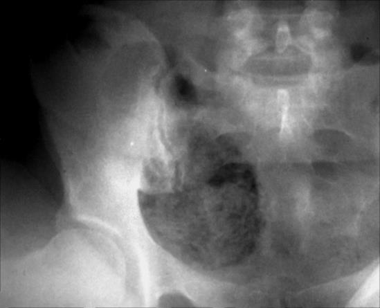 postoperativ spontan fistula