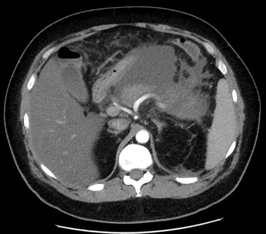 hypoalbuminaemia portalis hypertensio